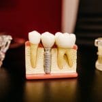 Dentística restauradora Entenda como funciona o curso de especialização para dentistas