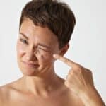 tratamento para rugas