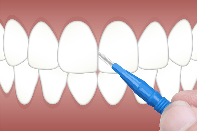 diferenças entre periodontite e gengivite